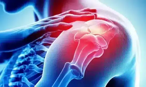 Best Approaches to Shoulder Injury Settlement Without Surgery